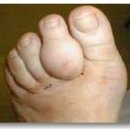 통풍으로 인한 발가락 및 손가락 관절 변형사진 이미지