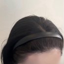 촘촘 스칼프 | [부산 헤어라인 커버]하와이스칼프