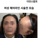 52 | 남양주두피문신 여성 헤어라인 가르마 고민 다닷스칼프 방문 후기