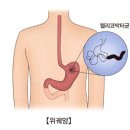 헬리코박터균 감염(Helicobacter pylori infection) 이미지