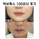 턱보톡스 &#34;100유닛&#34; 후기, 50유닛 100유닛 차이점, 고통정도, 시술상담 유의사항