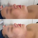 옥련동 피부관리✨ 송도 리프팅 효과 실화? 롬앤네일 온다핏 리프팅 후기💆🏻‍♀️