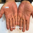재이한의원 | 수장족저농포증 손발바닥 건선 환자분 2개월간의 한약 복용 후기