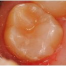 느낌이있는필치과의원 | 양구치과? 충치 레진치료 실패하시는 분들의 공통점 <의사 조언>