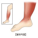 봉와직염(Cellulitis) 이미지