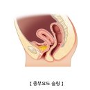 요실금 Urinary incontinence 이미지