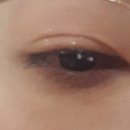 커풀 | 눈커풀 점인지 다래끼인지 제거 후기