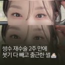 아라농원 | 쌍수 재수술 2주 만에 붓기 다 빼고 출근한 노비 | 완전절개 | 라인낮추기 | 재수술 | 절제 | 인아웃라인