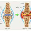 울산 박병원 - 류마티스 관절염 이미지