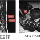 신천부부한의원 | [신천정형외과]신경성형술+고주파 수핵응고술을 같이 실시한 환자