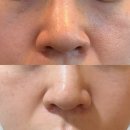 대구 물광주사 스킨보톡스 내돈내산 찐후기 물광주사붓기 엠보 멍 후기 신부관리