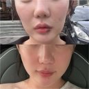 애프터스킨 | 광주 서구피부과 5세대 스킨부스터 셀르디엠 비포애프터 후기