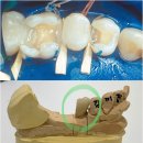 하이테크7치과기공소 | 부개동치과 충치단계 사진 증상 치아에까만점
