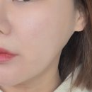 쿨 | 압구정 피부과 쿨소닉 리프팅 후기 효과 4천샷 솔직리뷰