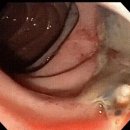 [일반] 내시경 도중 발견한 기생충..........ㅜ.ㅜ 이미지