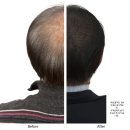 기산빅프라자 | 오류동 두피문신 후기, 비어있던 정수리가 꽉 차 보이는 마법 (feat. 코아더뷰티)