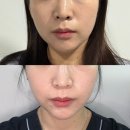 생피부관리실 | 대구동성로 피부과 물광피부관리 추천 엑사네르 효과 및 경과 후기