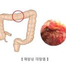 왼쪽 아랫배 누르면 통증 원인과 증상: 복부 땡김과 묵직함 찌릿함 이미지