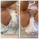 주식회사 피코셀 | 아토피피부염이 사라졌다고??