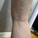 우산약국 | [비 오는 날 산책 주의] 논밭 물웅덩이 빠진 후 갑작스러운 두드러기! 약국 카네손크림 4일 사용 찐후기