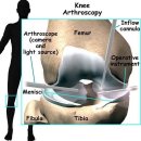 [십자인대파열,십자인대수술]-전방십자인대 파열시 받는 치료는? 관절내시경수술 이미지