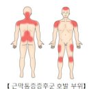 근막동통증후군 원인 대처법 이미지