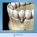 임플란트 고민 된다면? 지금 당장 쌍문역 치과 이미지
