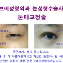 안검하수 원인,수술시기,부작용예방법[대구눈성형,대구보톡스] 이미지