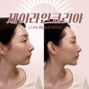 77 | 대구 동성로 윤곽관리 추천｜제이라인코리아 울리푸 관리 받고 온 솔직후기