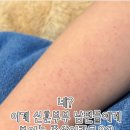 이호표피부과의원 | 신혼부부에게 흔한 팔 두드러기? 원인은 ‘이 행동’ [팩트진찰대]