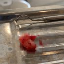 신림신경과의원 | 서울 관악 신림 치과 매복사랑니 발치 후기 &amp; 사랑니 실비 청구