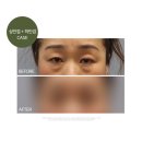 뉴원성형외과의원 | 여수성형외과 상안검과 하안검수술 후기