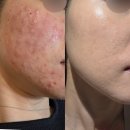 알파레저 | 여드름흉터 치료에 무통 리쥬란HB 맞은 이유 (힐러 차이점, 통증, 효과)