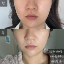 바른빛피부과의원 | 수원 인계동 세모아의원 v슬림핏레이저 티타늄리프팅으로 v라인된 후기