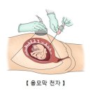 Rh 부적합 임신 (Rh Incompatibility pregnancy) 이미지