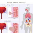 방광암 생존률 및 예방법 이미지