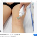 족저근막염 정형외과 물리치료 체외충격파 후기