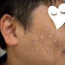 엘리트약국 | 밴스의원수지 : 정직한 가격, 좋은결과를 추구하는 곳 밴스의원수지점에서 #얼굴편평사마귀제거후기.