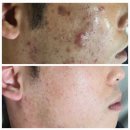 해운동015 | 다른 곳은 왜 안 되던 게 라라라뷰티 슈퍼젝션은 될까/마산슈퍼젝션전문