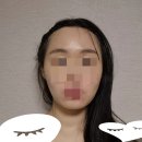 다음 | 효과짱 이마축소 다음날~일주일 후기 (통증 출근 연고바르기팁)