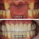 이로운치과의원 | 인천양심치과 예온치과 &#34;다른 곳에서 전체 임플란트밖에 방법이 없다고 하셨나요?&#34;