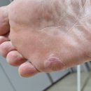 (766 감사일기) 신신 티눈밴드
