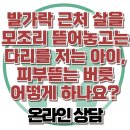 [온라인상담: 발가락 근처 살을 모조리 뜯어놓고는 다리를 저는 아이, 피부뜯는 버릇 어떻게 하나요?] 한국아동청소년심리상담센터 이미지