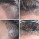 미다모은 | 여성헤어라인 미다모클리닉 비절개 헤어라인교정수술