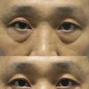 거제비타민씨 | 거제눈밑지방재배치 관리방법, 일상 복귀 전 확인해야 할 체크리스트 7가지