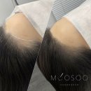 햇빛헤어라인 - 북구 | 햇빛헤어라인