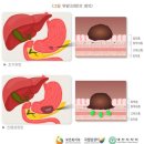 흉복부장기 또는 비뇨생식기 기능에 심한 장해를 남긴 때(75%)[혈액투석:주3회] 이미지