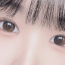 디데이성형외과의원 | [눈성형 4달차] 디데이성형외과 자연유착+눈매교정+앞트임, 이젠 진짜 내 눈 같아! (전후사진有) 💛