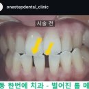 이사이치과의원 | 이사이 틈 메우기. 치아삭제없이 틈메우는 법 - 명동 한번에치과 후기