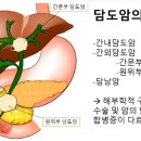 담도암 최신 항암치료 - 면역, 표적항암제 / 황달, 스텐트 시술, 아브락산, 오니바이드, 젬시타빈, 시스플라틴 이미지